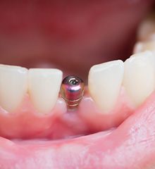 patient smiling after getting dental implant