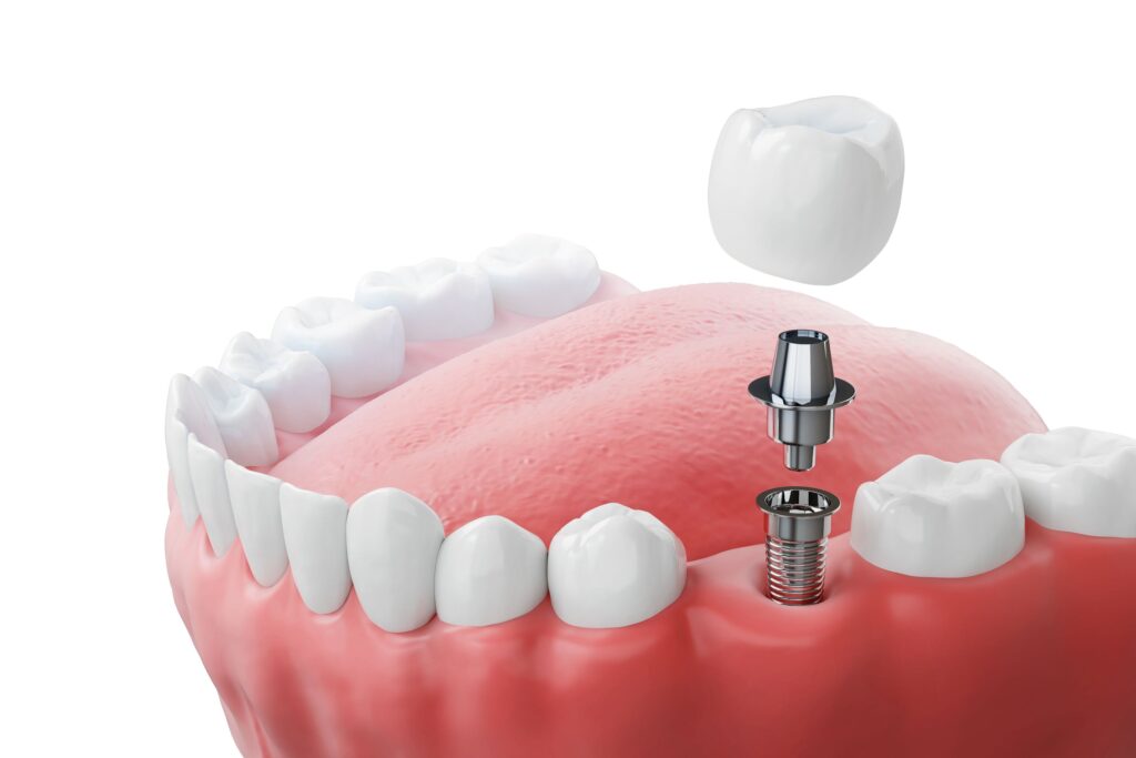 3D illustration of a dental implant in a lower arch with white background